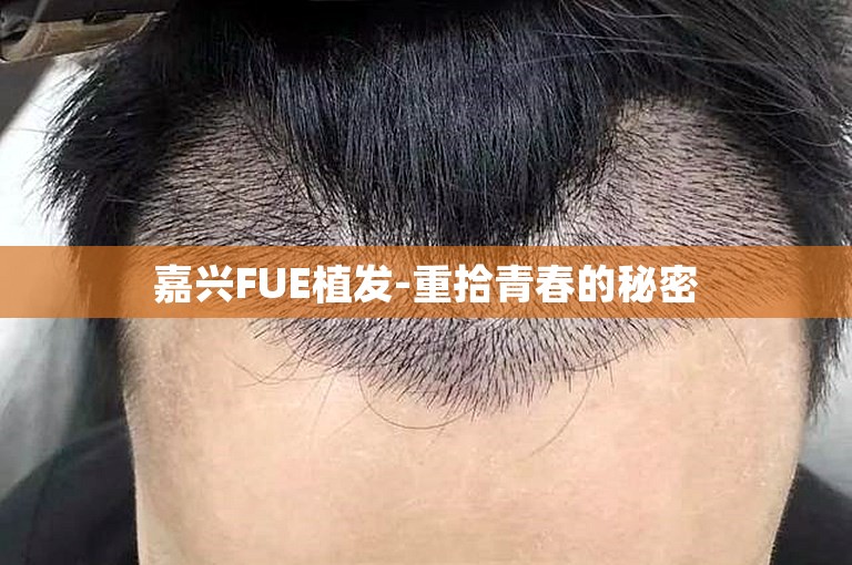 嘉兴FUE植发-重拾青春的秘密