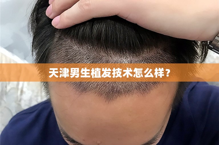 天津男生植发技术怎么样？