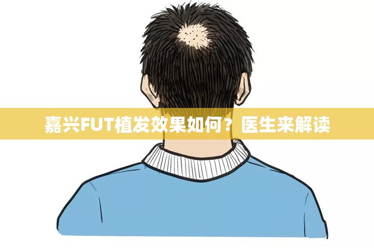 嘉兴FUT植发效果如何？医生来解读