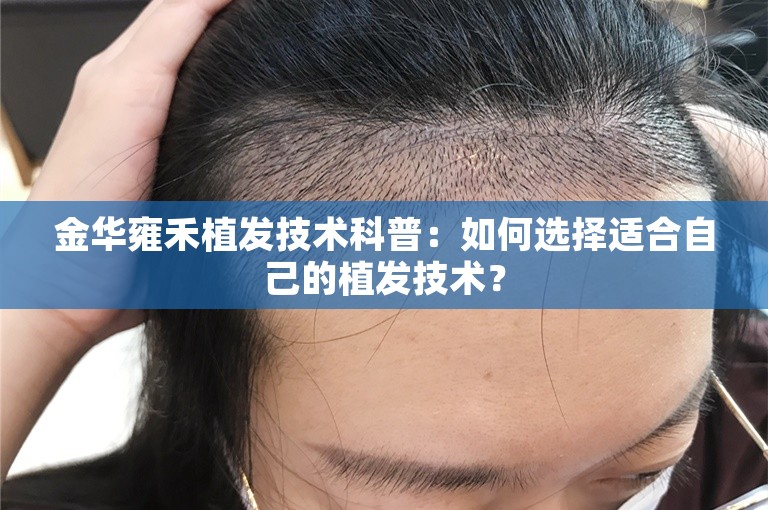 金华雍禾植发技术科普：如何选择适合自己的植发技术？