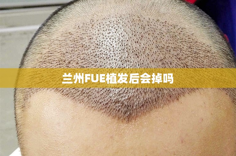  兰州FUE植发后会掉吗 