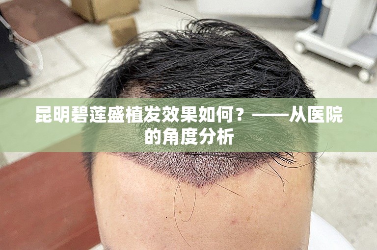 昆明碧莲盛植发效果如何？——从医院的角度分析