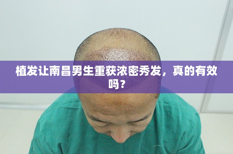 植发让南昌男生重获浓密秀发，真的有效吗？