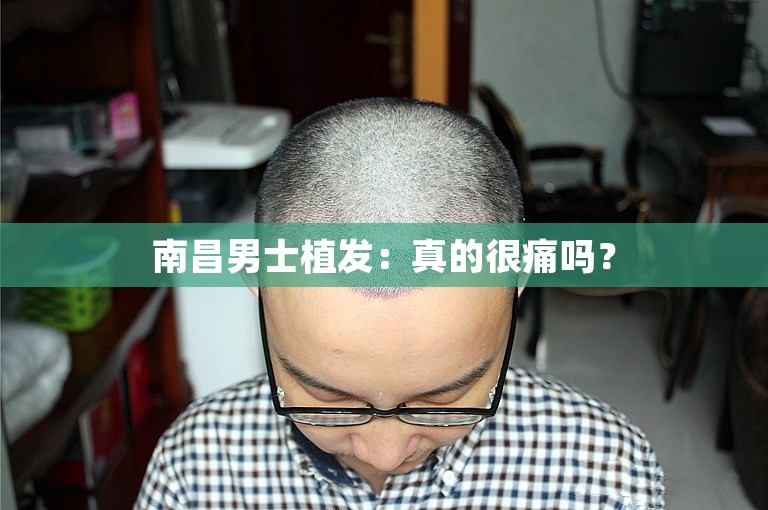 南昌男士植发：真的很痛吗？