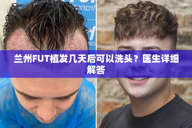 兰州FUT植发几天后可以洗头？医生详细解答