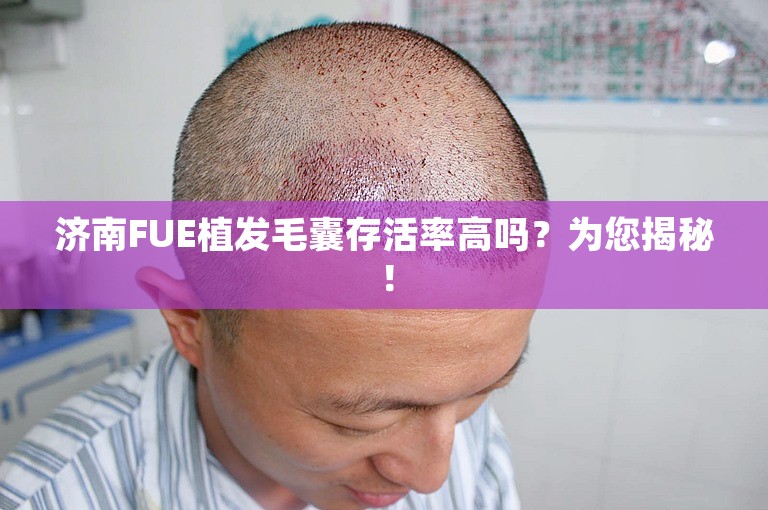 济南FUE植发毛囊存活率高吗？为您揭秘！