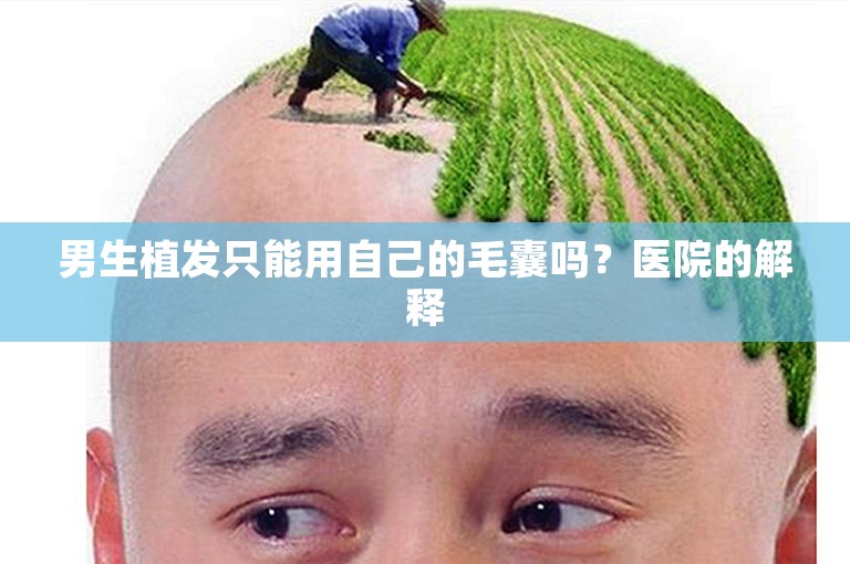 男生植发只能用自己的毛囊吗？医院的解释