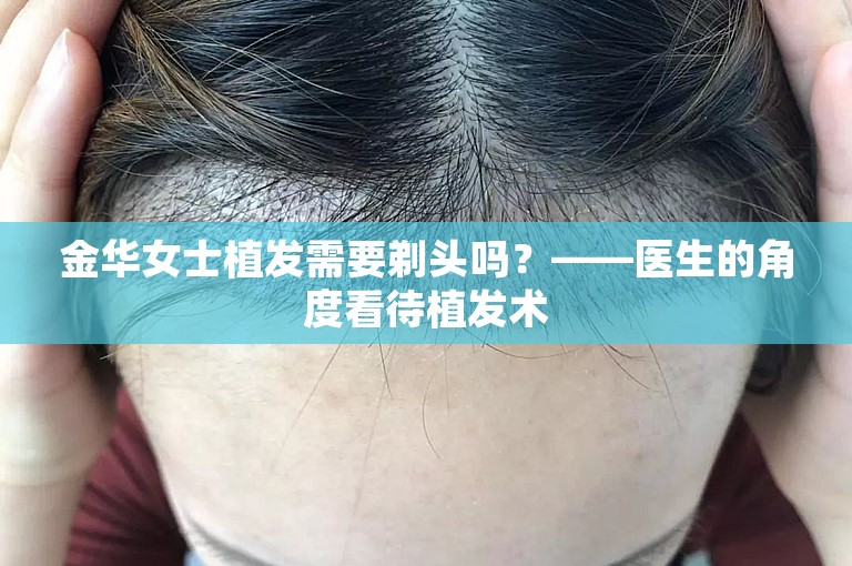 金华女士植发需要剃头吗？——医生的角度看待植发术