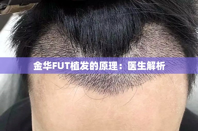 金华FUT植发的原理：医生解析