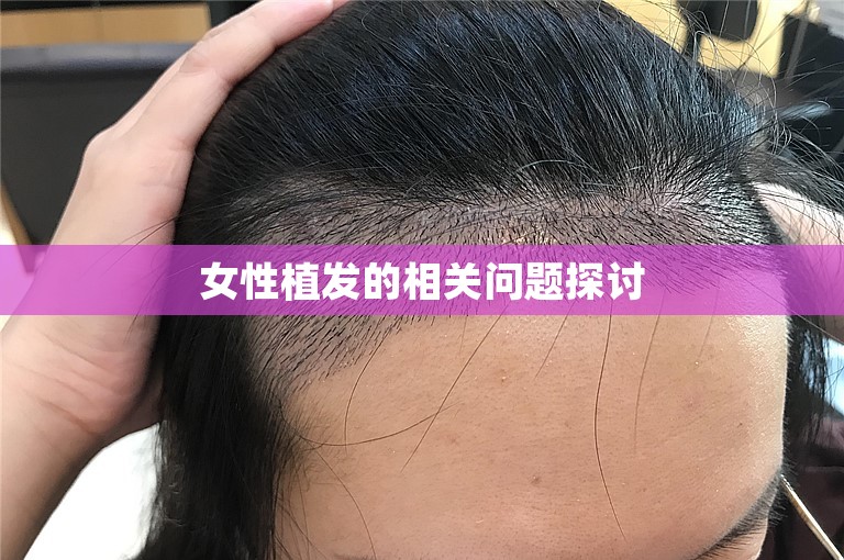 女性植发的相关问题探讨