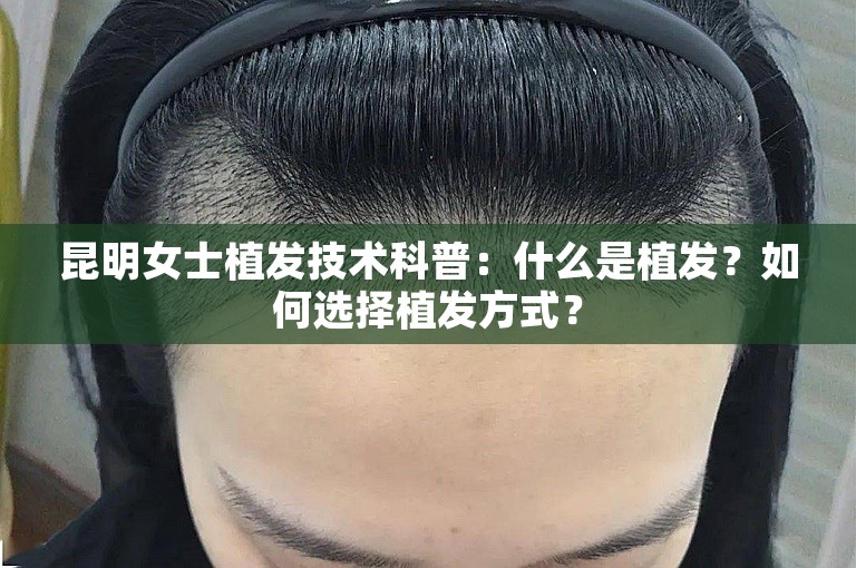 昆明女士植发技术科普：什么是植发？如何选择植发方式？