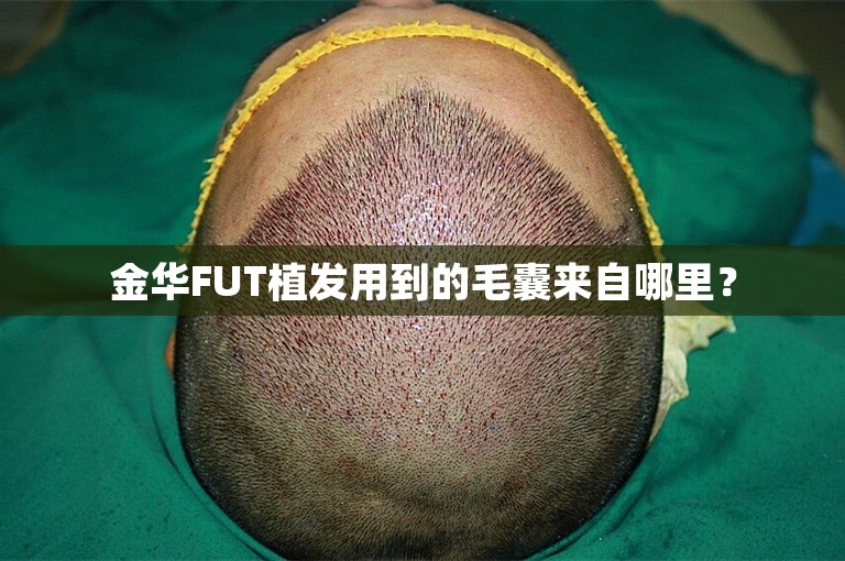 金华FUT植发用到的毛囊来自哪里？