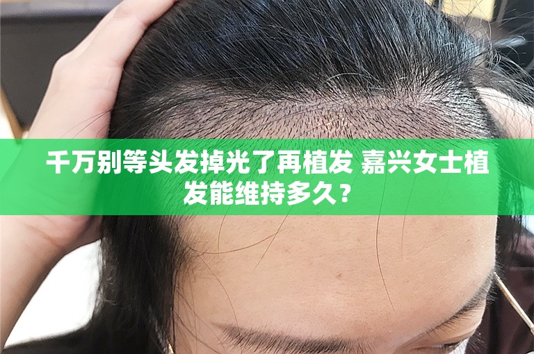 千万别等头发掉光了再植发 嘉兴女士植发能维持多久？