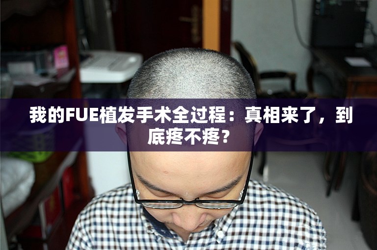  我的FUE植发手术全过程：真相来了，到底疼不疼？