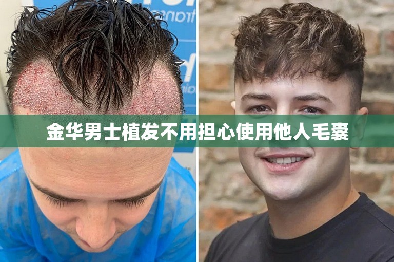 金华男士植发不用担心使用他人毛囊