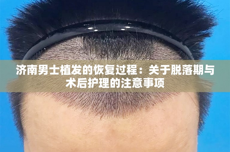 济南男士植发的恢复过程：关于脱落期与术后护理的注意事项