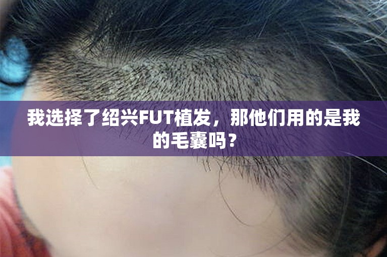 我选择了绍兴FUT植发，那他们用的是我的毛囊吗？