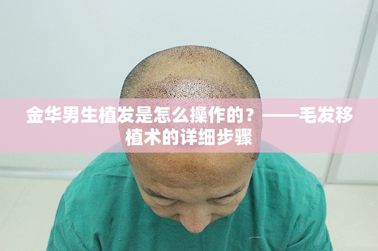 金华男生植发是怎么操作的？——毛发移植术的详细步骤