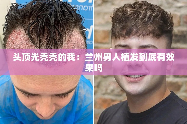 头顶光秃秃的我：兰州男人植发到底有效果吗