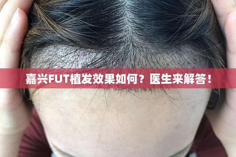 嘉兴FUT植发效果如何？医生来解答！