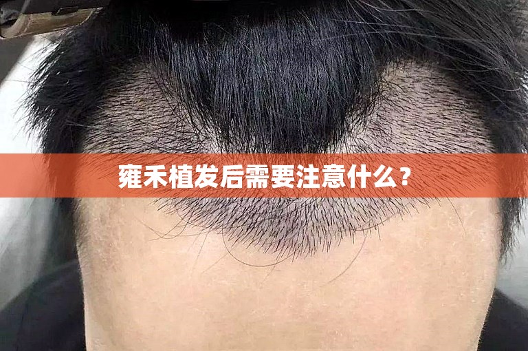 雍禾植发后需要注意什么？