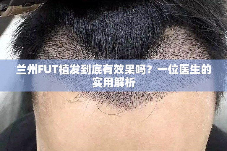 兰州FUT植发到底有效果吗？一位医生的实用解析