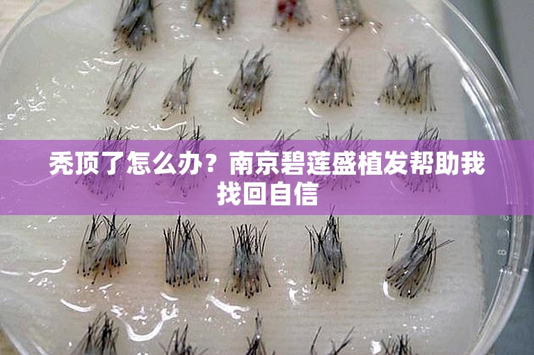 秃顶了怎么办？南京碧莲盛植发帮助我找回自信