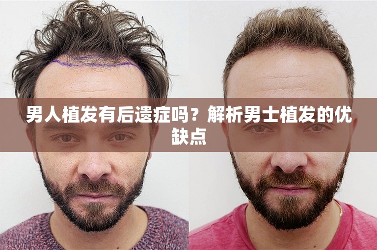 男人植发有后遗症吗？解析男士植发的优缺点