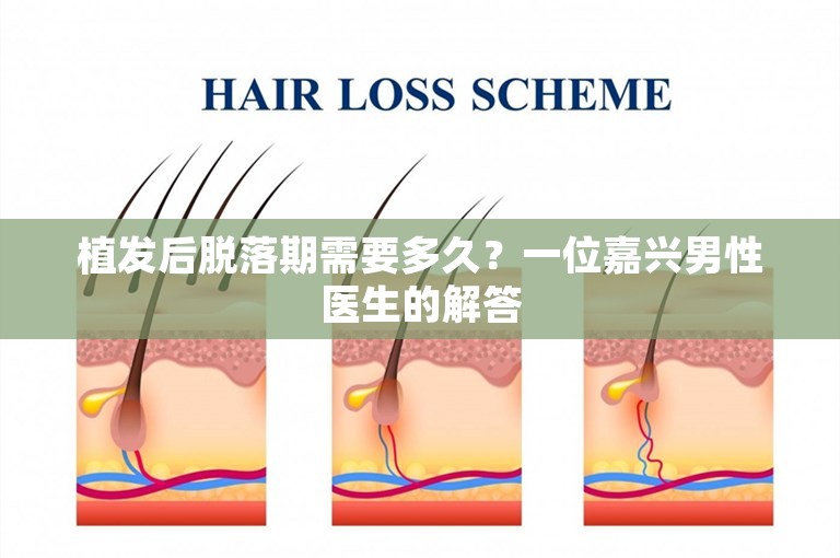植发后脱落期需要多久？一位嘉兴男性医生的解答