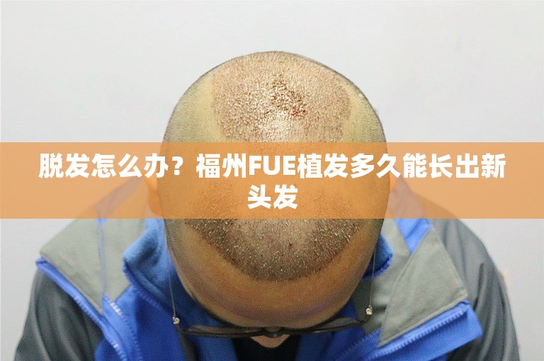 脱发怎么办？福州FUE植发多久能长出新头发