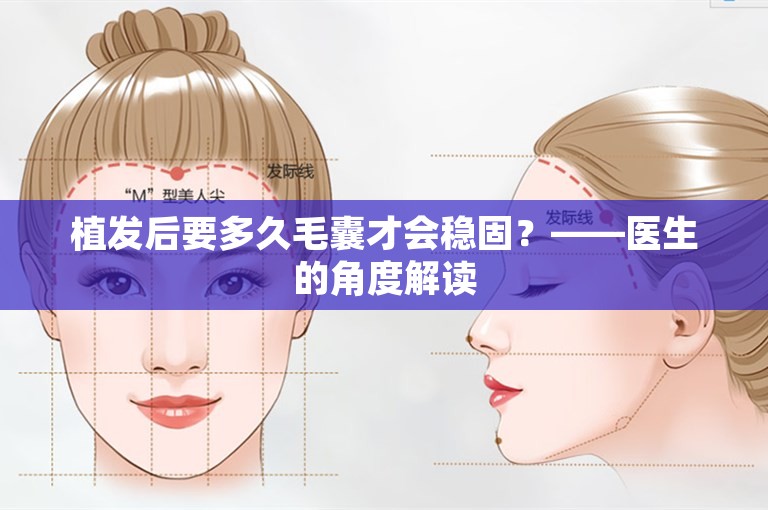 植发后要多久毛囊才会稳固？——医生的角度解读