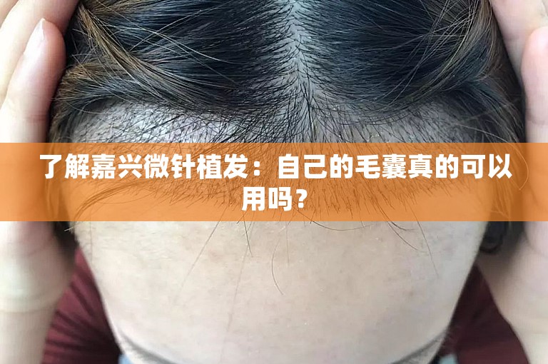 了解嘉兴微针植发：自己的毛囊真的可以用吗？