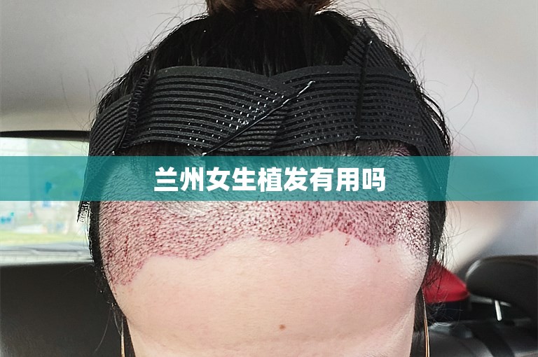 兰州女生植发有用吗