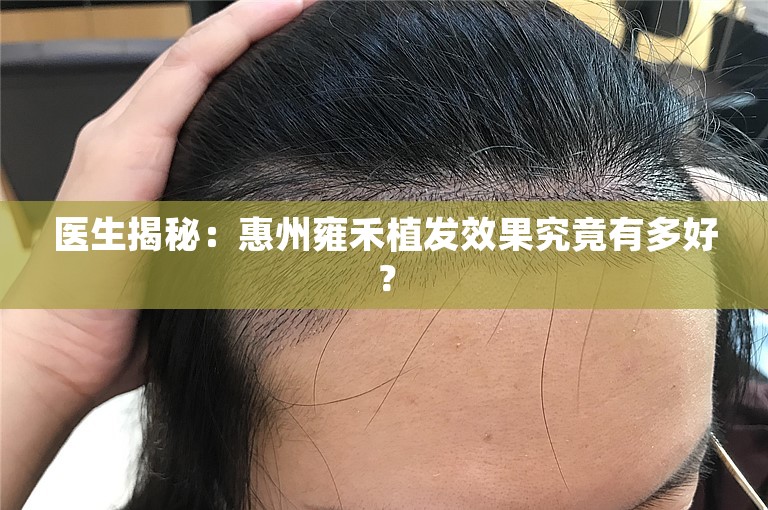 医生揭秘：惠州雍禾植发效果究竟有多好？