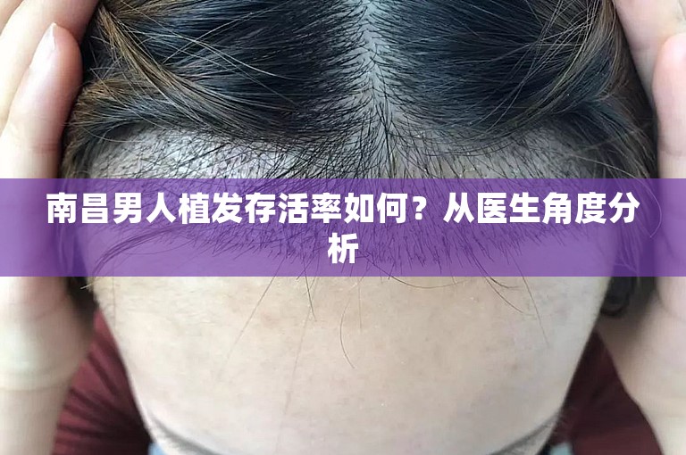 南昌男人植发存活率如何？从医生角度分析