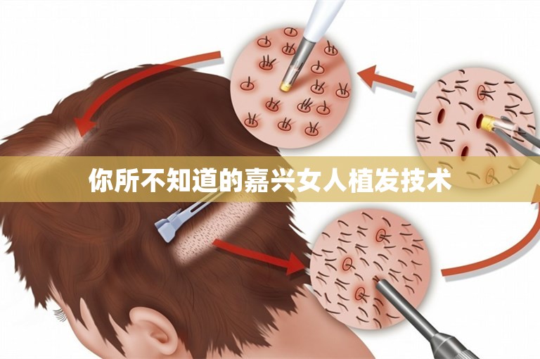 你所不知道的嘉兴女人植发技术