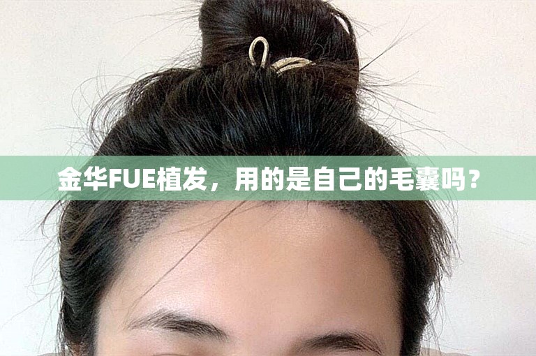 金华FUE植发，用的是自己的毛囊吗？