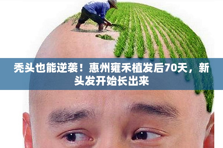 秃头也能逆袭！惠州雍禾植发后70天，新头发开始长出来