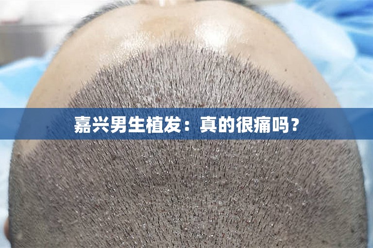 嘉兴男生植发：真的很痛吗？