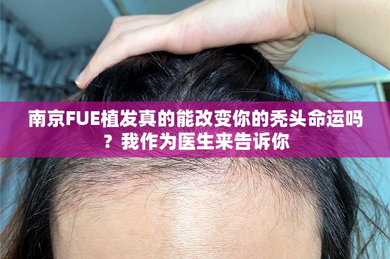 南京FUE植发真的能改变你的秃头命运吗？我作为医生来告诉你