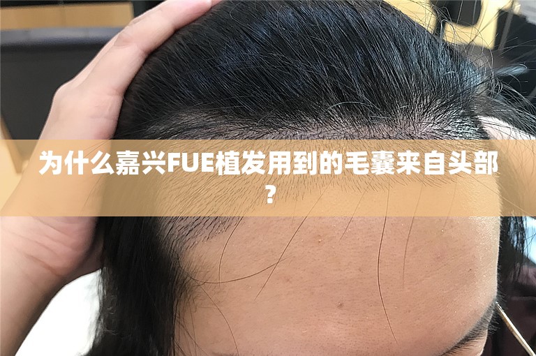 为什么嘉兴FUE植发用到的毛囊来自头部？