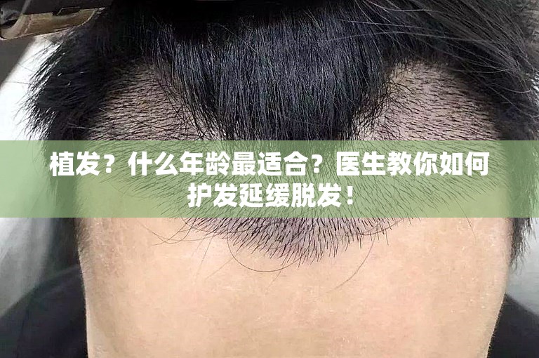 植发？什么年龄最适合？医生教你如何护发延缓脱发！