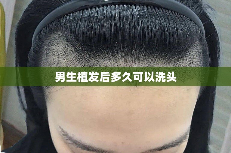 男生植发后多久可以洗头