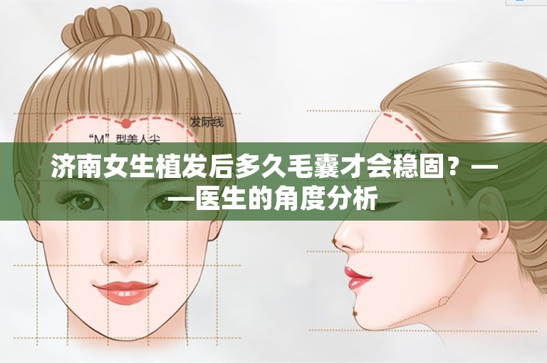 济南女生植发后多久毛囊才会稳固？——医生的角度分析