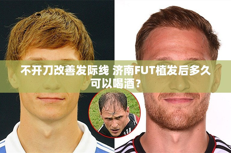 不开刀改善发际线 济南FUT植发后多久可以喝酒？