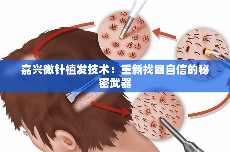 嘉兴微针植发技术：重新找回自信的秘密武器