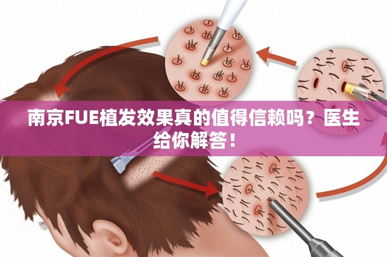 南京FUE植发效果真的值得信赖吗？医生给你解答！