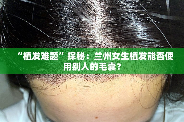 “植发难题”探秘：兰州女生植发能否使用别人的毛囊？