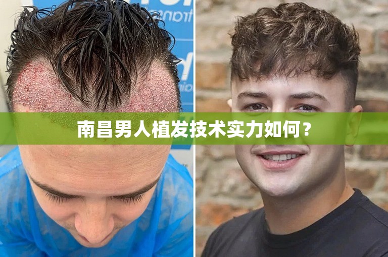 南昌男人植发技术实力如何？