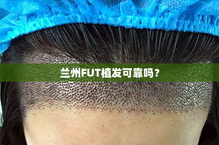 兰州FUT植发可靠吗？